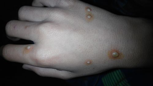 孩子水痘成了这样的,大夫帮忙看看正常吗?