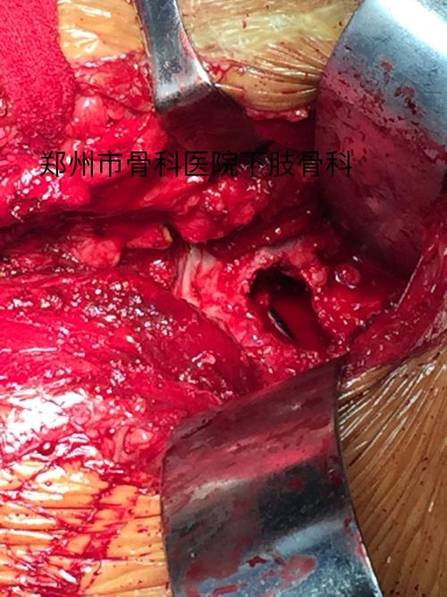 前方开窗,断端彻底清理,去除断端纤维疤痕至新鲜骨创面,渗血