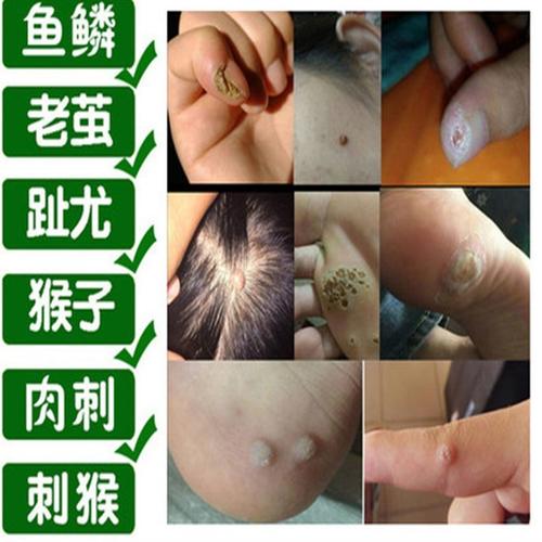 跖疣刺猴老茧肉丁瘊子草本鸡眼贴脚趾手工鸡眼贴膏去除