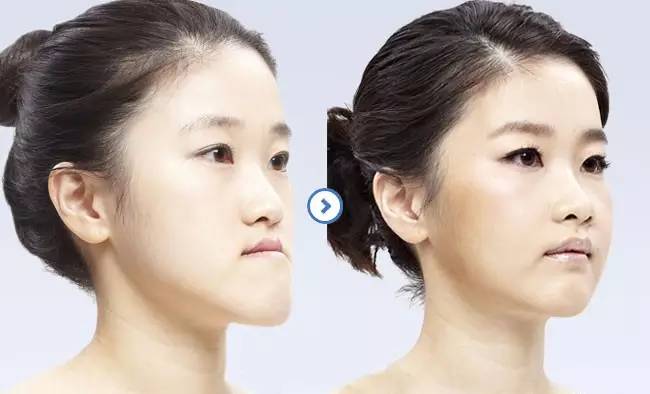 "地包天"的最佳治疗时间