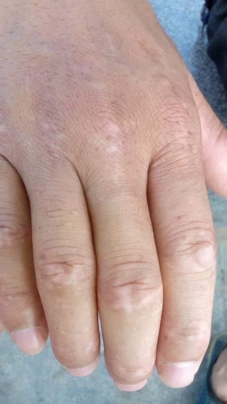 问:朋友手上有点点白是怎么回事?