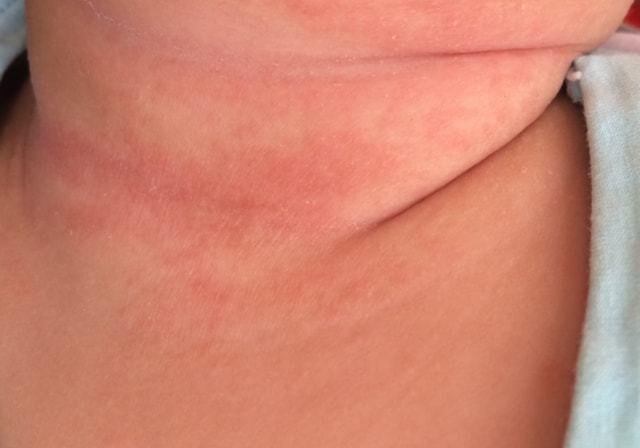 婴儿湿疹的诊断主要依据症状,也就是皮疹的形态,一般不需要做特殊的