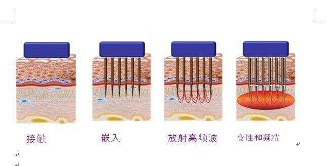 微针的工作原理