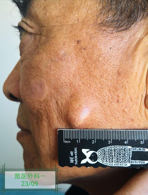 面部肿物(皮脂腺囊肿)切除