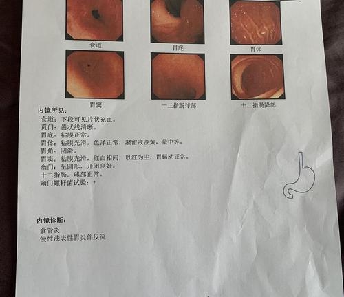 食管炎 慢性浅表性胃炎伴反流严重吗