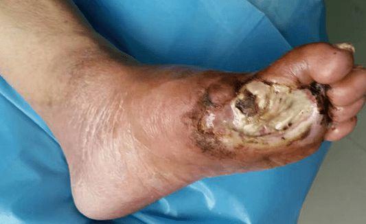 糖尿病足烂脚怎么有效治疗?