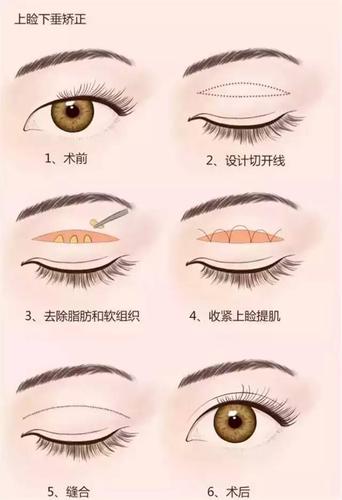 双眼皮整形最热关键词详解