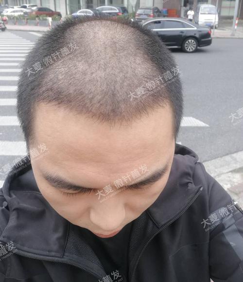 术后16天】不知不觉做这个植发快有半个月了,没啥特殊的情况,现在恢复