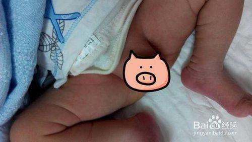 常见的有小鸡鸡外皮发红和尿道口发红两种.