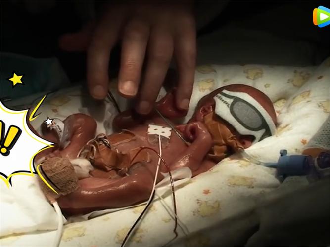 24周加4天的早产儿,体重只有667克,与妈妈的握手惹人泪目