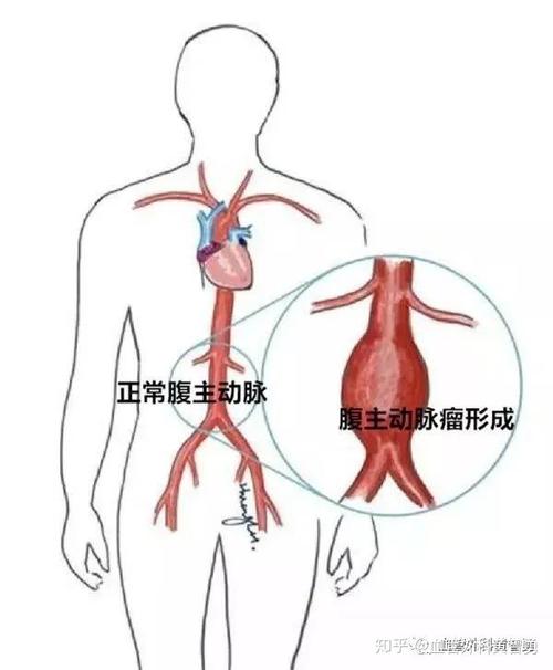 「名医访谈」系列之——腹主动脉瘤常见问题解答