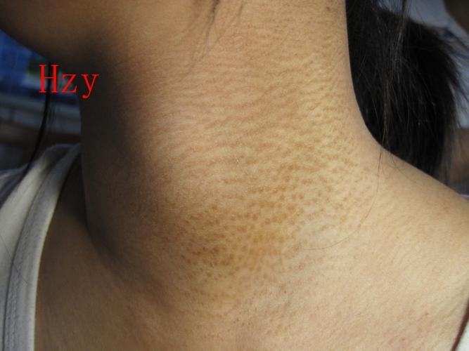 板凳回复小棉花鹿2010-06-17 22:49:59播散性复发性漏斗部毛囊炎 4楼