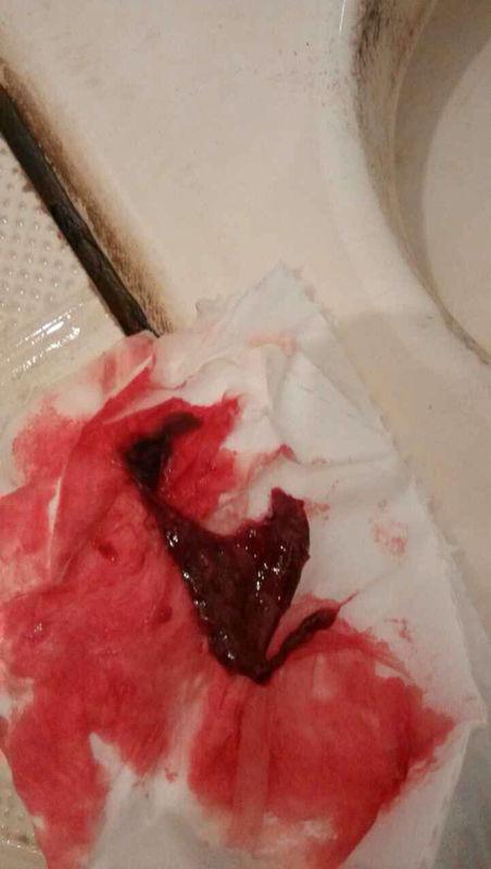 做完人流后内裤上有白色的,是属正常现象 太久没运动,跑两圈胸痛,属