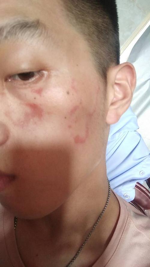 花斑癣~啊啊啊啊啊啊啊脸上起了癣 得怎么治疗 不痛不痒 答题抽奖