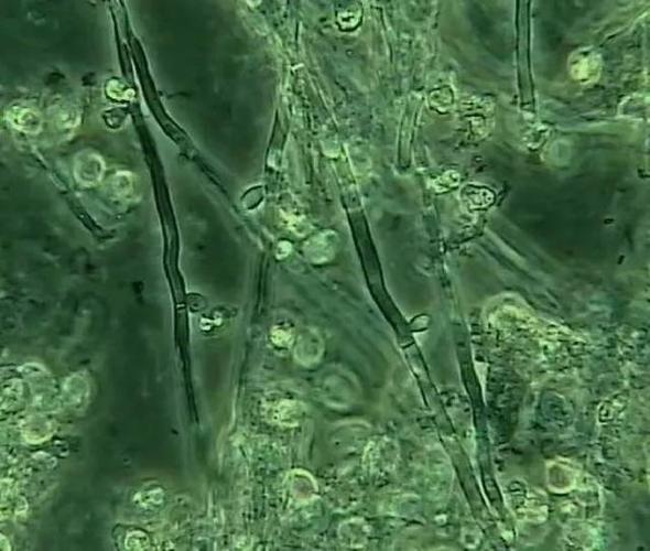 而常见的外阴阴道假丝酵母菌病(vvc)则能在镜下检出真菌菌丝或芽生