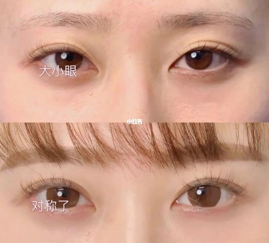 后悔做7毫米的双眼皮了_双眼皮_凡尔赛_欧式_武汉双眼皮_美妆_医美