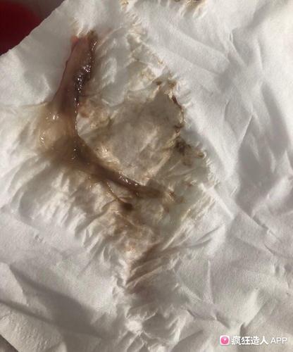 [试管婴儿](有图慎入)孕晚期流了些跟果冻似的分泌物,是快生了吗