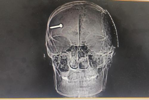 患者脑部ct片子,钉子清晰可见.
