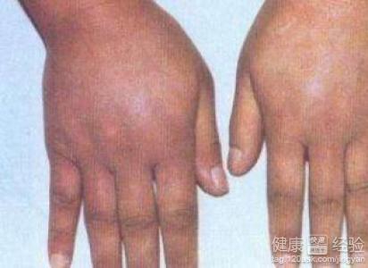 药物性水肿怎么引起的