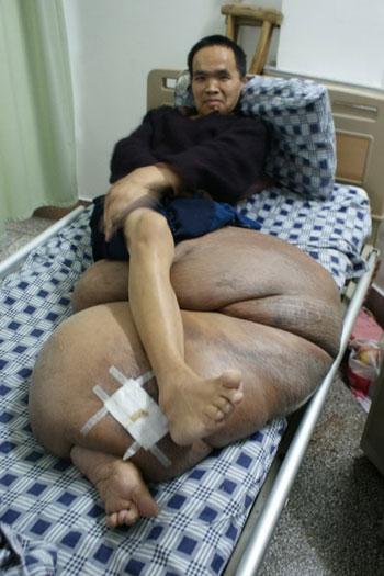 彩票-男子体重100公斤肿瘤占一半 巨腿拖累他15年
