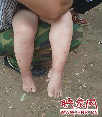 濮阳5岁男童患大头病 没钱治病家人放弃治疗