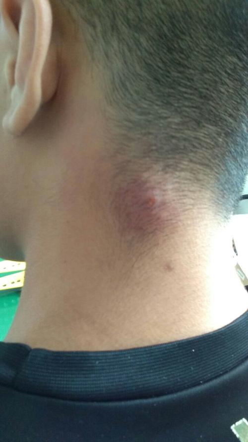 这个是什么毒疮,需要怎么样医疗法