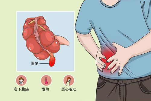 口腔执医考试急性阑尾炎是怎么引起的