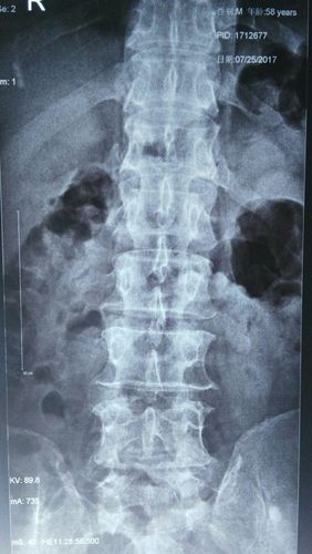 临洮县中医院—游离型腰椎间盘突出,经椎间孔镜微创手术治疗成功一例