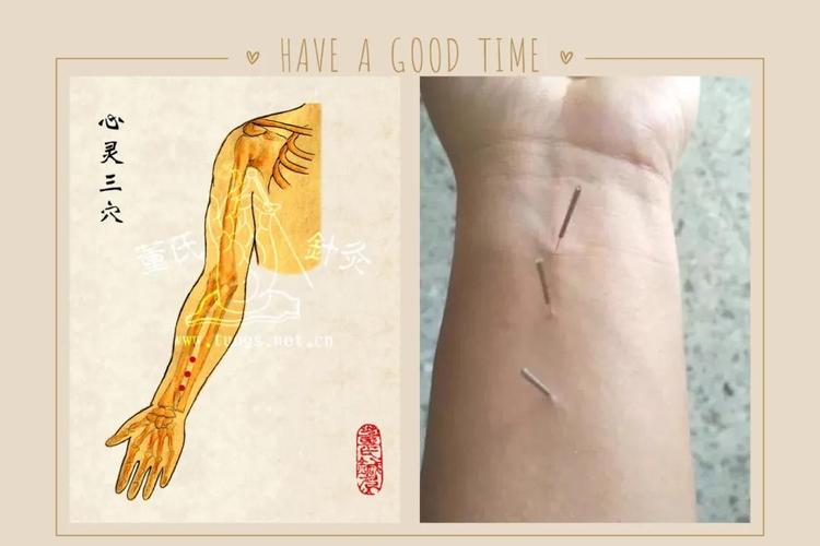 世界董氏奇穴第二代嫡系传人郑承浚博士正统奇穴病症处方膝关节病痛