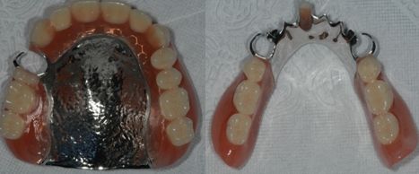 病例4:患者的情况相对比较复杂,也选择了vitallium的局部义齿设计