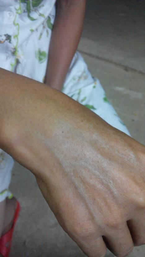 一弯下的时候是鼓起来的,还会痛,是皮肉痛的,不是骨痛,去医院拍