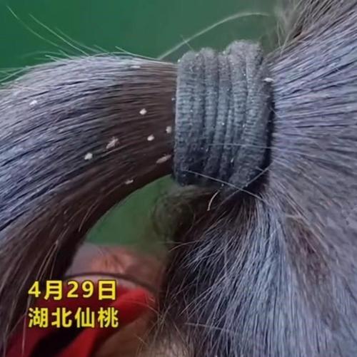 湖北女孩虱子满头爬只因父母在外务工不在家可怜又可悲