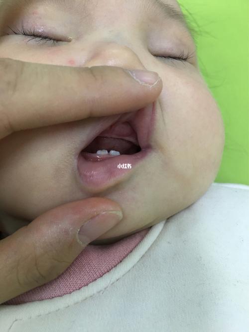 宝宝5个半月了,近期才发现上牙龈很鼓,不知道是什么原因,可能生出来也