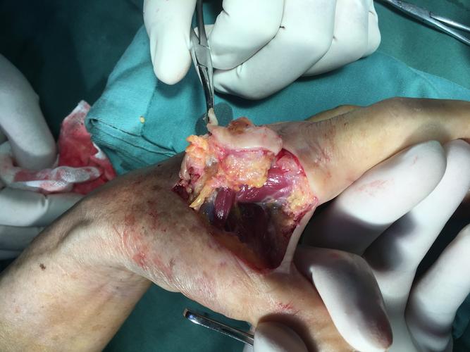 一例皮肤恶性肿瘤,左手虎口处肿物渐进性增大伴反复溃烂3年,入院初步