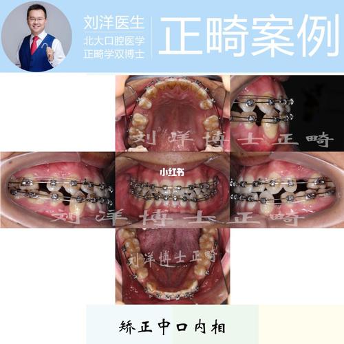 刘洋医生牙齿矫正|骨性地包天非手术纯正畸_牙齿矫正