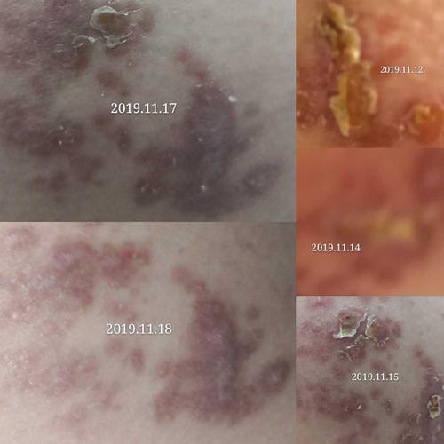 带状疱疹全过程回顾