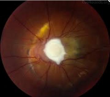 11岁童爱狗如胶似漆 染眼弓蛔虫病险失明