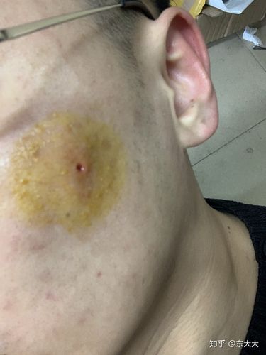 记一次脸上张疖子的悲惨遭遇