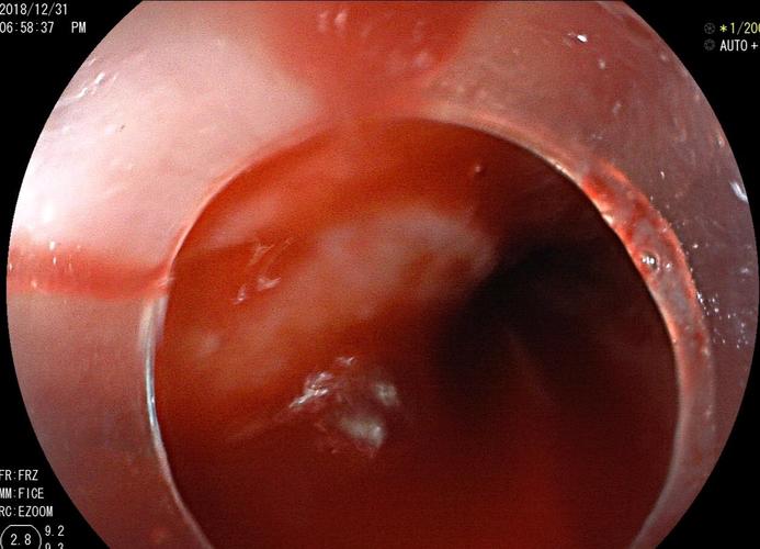 惊心动魄的胃溃疡大出血