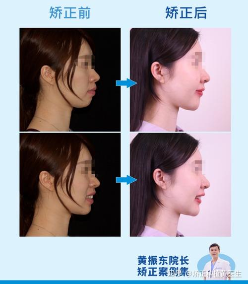 龅牙和下巴后缩矫正之后和矫正前变化有多大?