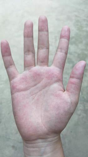 癌症,手纹怎么看