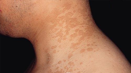 汗斑怎么治才能根除 汗斑真的能晒太阳吗