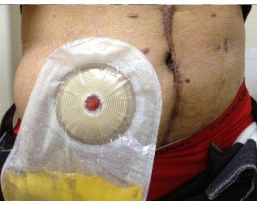 临床上需造口手术的患者人数众多,造口后造口旁疝的发生率可高达40%