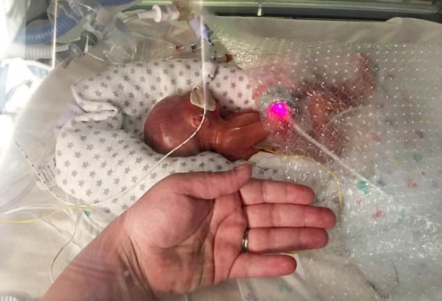 孕妇产下22周大的宝宝, 体重仅0.6公斤