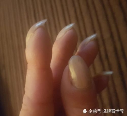 英国女子晒指甲异常弯曲,后来才知道是肺癌信号!