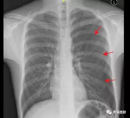 右侧气胸(肺被压缩约70%) ↓:气带宽度略大于患侧胸廓的1/2,右肺明显