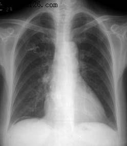 消化道穿孔诊断图片