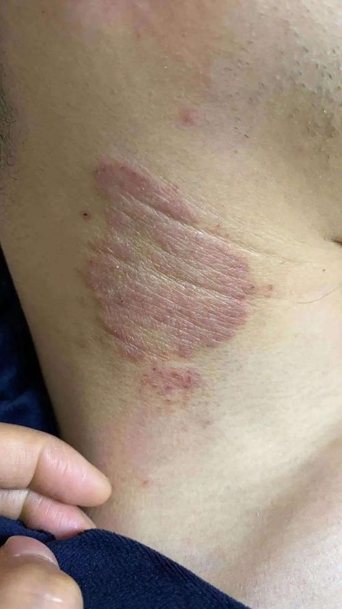 也许大家都有点误解,以为牛皮癣只是皮肤过敏,或者普通的神经性皮炎