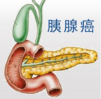 胰腺癌的治愈案例