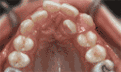 【图文科普】七大牙齿矫正的动态过程图